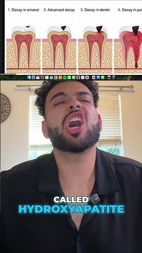 Fluoride Tooth Repair: Demineralization Explained!