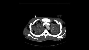 Computed Tomography of the pulmonary artery in an Axial plane for diagnosis of pulmonary embolism in a patient with active pulmonary Tuberculosis showing normal vascular anatomy.
