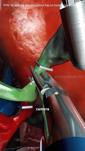 Gallbladder removal surgery #medical #medical3d #medical3danimation#urine #gallbladder