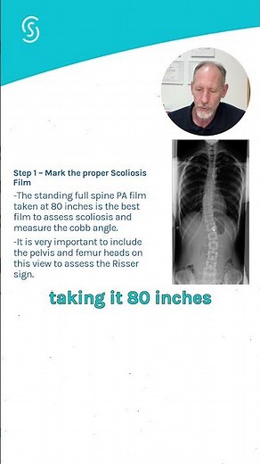 Measuring Scoliosis Correctly