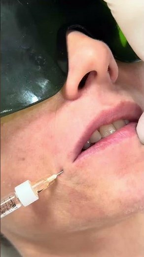 💉👄 Hyaluronic acid lip injections: between perception and reality