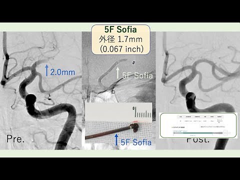 5F Sofia 脳梗塞血栓回収カテーテルの使いどころ