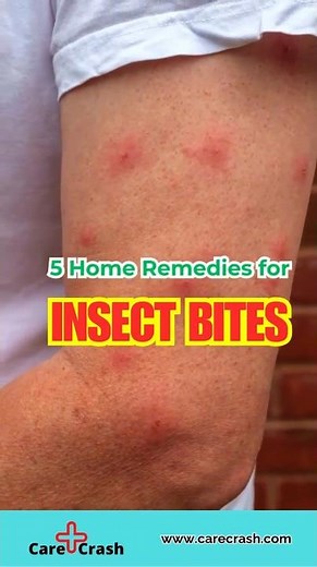 5 Soothing Insect Bites Home Remedies | #carecrash