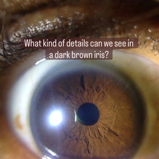 Hayley •Natural Physician •Master Iridologist •Herbal Medicine on Instagram: "🤎What kind of details can we see in a dark brown iris?🤎 ✨ Although it is harder to see details with the naked eye, one simply needs to utilize a light and a magnifier, and the universe within the individual is revealed! 🤎In a true brown iris we can see markings related to the current state of the blood, the lymph, all of the organs, the endocrine system (hormones), nervous system, emotion, digestive system, soul con