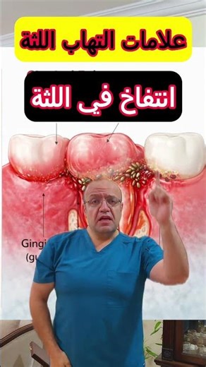 علامات التهاب اللثة #التهاب_اللثة #ضعف_الانتصاب #انتصاب #اسنان