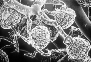 Insuffisance rénale · Inserm, La science pour la santé