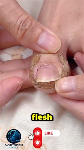 Product Link in Bio (#429 ) ✅ Toe Align Ingrown Nail Corrector Stickers #shorts