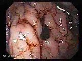 Dieulafoy´s Lesion (Exulceratio Simplex) (1 of 9) • Video • MEDtube.net