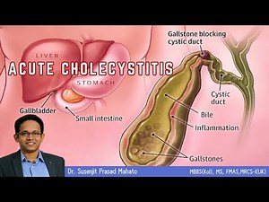 What is Acute Cholecystitis !!??
