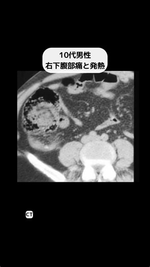 れい🩺放射線科診断専門医 on Instagram: "急性虫垂炎 救急外来で遭遇することの多い急性腹症の一つです。 最近は抗菌薬投与後、待機的に手術することも多くなっています。 典型的な症状を示さない症例も多く、診断には画像診断が非常に有用です。 本動画は放射線科診断専門医が作成した、医療従事者向けの教育用コンテンツです。 ※個別のご相談には対応しておりません。 ※使用している画像はすべて生成AIによるもので、実在する患者さんの画像ではありません。 #画像診断 #放射線科 #医療従事者向け #急性腹症 #ct"
