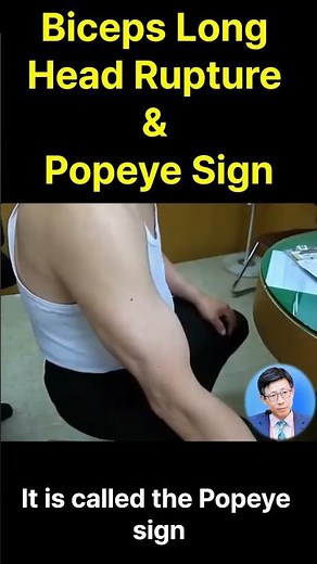 RPopeye's Arm Unmasked: The Long Head Biceps Rupture Story 뽀빠이 팔의 비밀: 이두근 장두 파열의 실체