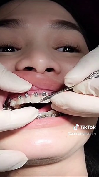 Braces Update and Adjustment - Zaira Monzon Shares Orthodontic Experience