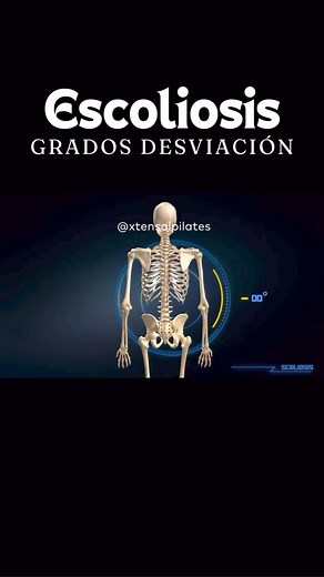 🔍 Clasificación Detallada de la Escoliosis: Entendiendo los Grados y Tipos 🔍1. Clasificación por Ángulo de Cobb:Leve: 10-25 grados 📏Moderada: 26-40 grados 📐Severa: 41-50 grados 🏗️Muy severa: más de 50 grados 🚨El ángulo de Cobb es fundamental para determinar el tratamiento; las intervenciones pueden variar significativamente entre los casos leves y los muy severos.2. Clasificación según la Localización de la Curva:Cervical: Involucra la región cervical de la columna. 🆙Torácica: Afecta prin