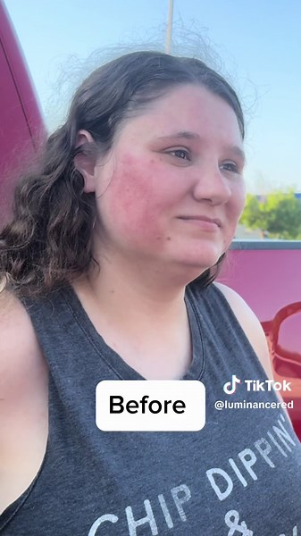 She brought out the TAZER😭😭 but the RESULTS are actually insane.. 😱link in bio to purchase! #fyp #foryou #foryourpage #fypシ゚viral #redlight #foryourpagetiktok #xybca #luminancered #viral #viralvideo #fypシ #foryoupage #tiktokmademebuyit