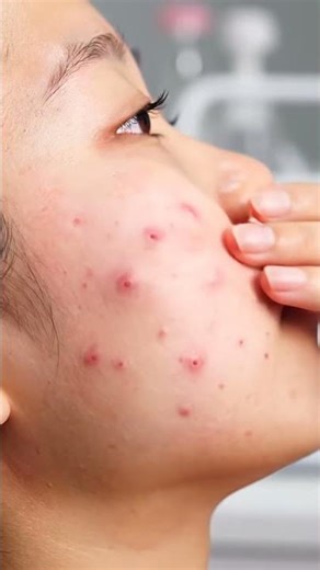 “Extreme Pimple Removal – So Satisfying to Watch!”