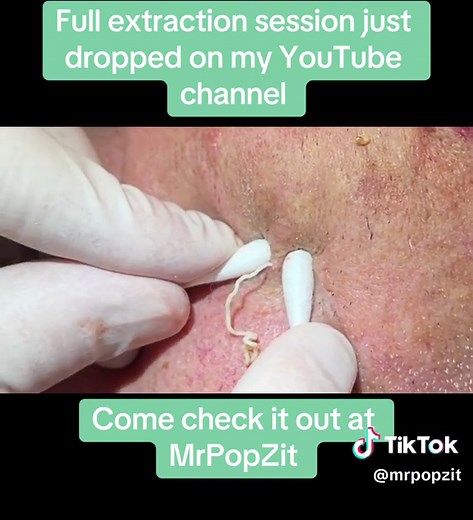 Full extraction session just posted on my youtube channel at MrPopZit. #medicaleducation #dermatology #mrpopzit #mrpopzitlive #skincare #skin #youtube #youtuber #popaholic #physicianassociate #extraction #dermatologypa #acne #skincaretips #cloggedpores