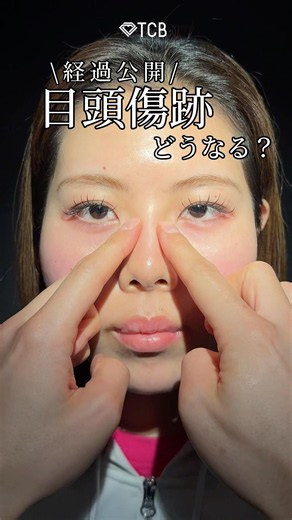 What happens to inner corner incision scars? #shorts
