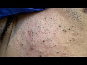 [ASMR] Deep Cleansing Techniques for Clear Skin and Blackheads Removal