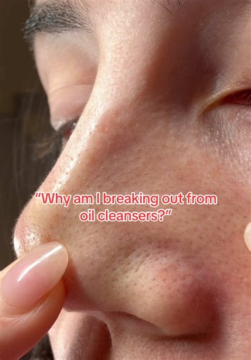 Do you break out from using oil cleansers? Here’s the thing, it might not be the oil, it might be the method. These are 3 steps you can’t skip: 1. Choose the right oil, Look for hypoallergenic and non-irritating formulas that support your skin barrier. 2. Emulsify every time, Adding water to break down the oil is key to preventing clogged sebaceous filaments. 3. Follow up with a gentle second cleanse — This ensures there’s no residue left behind that could lead to breakouts @anua_global #anua #d