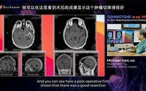 连接组学周周谈：切除复发性胶质母细胞瘤案例
