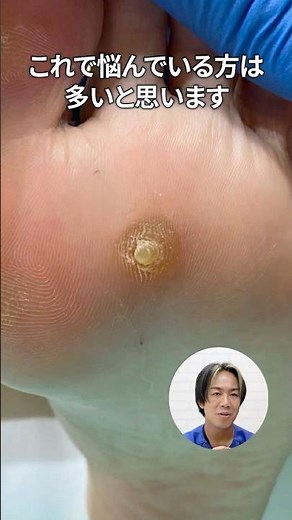 【BeforeAfter】様々な魚の目をご紹介！魚の目はできやすい場所があります！
