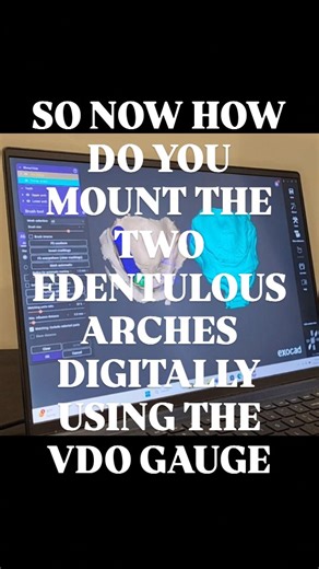 🎯 Digital Dentistry meets precision! In this reel, I’m using Exocad to digitally mount two edentulous arches with the help of the MOD Institute’s VDO Gauge System 🦷✨ By aligning common points between the intraoral scans and the PVS light body wash of the mush putty bite, we can accurately mount the arches digitally at the correct VDO — setting the foundation for a perfect digital denture workflow. This step is where art meets technology — and where precision pays off! 💻 Digital Workflow | 🦷 