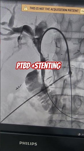 Ptbd and Stenting for Jaundice #livercancer #livertumor #PTBD