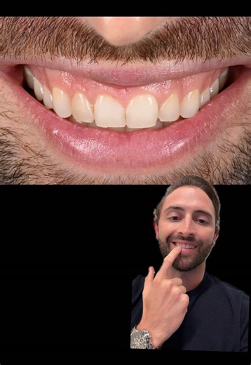 “Why don’t dentists have porcelain veneers?” We hear this question all the time and I got quite a few messages after yesterdays video asking me the same thing. So today I am reviewing…my own smile makeover which consisted of 12 porcelain veneers and a gum raise. I previously have 2 bondings (composite veneers) and a chipped edge of my front tooth. As someone who grinds their teeth, I was constantly having to get the edges of the bondings redone and repolished to deal with the color change. Now, 