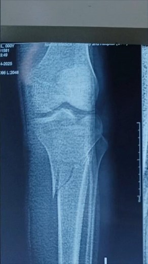 What Happens to the Knee After Tibial Plateau Fracture Surgery? #knee #kneepain #tibia #plate #ortho