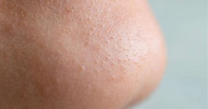 Dermatologista dá dicas de como amenizar poros dilatados