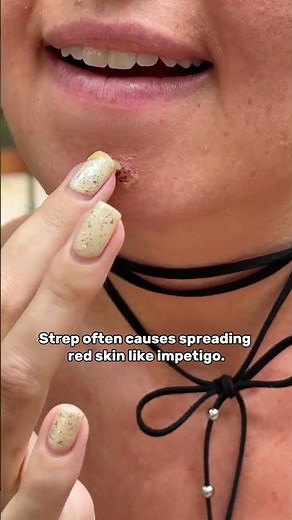 Staph vs Strep: Do You Know the Difference?