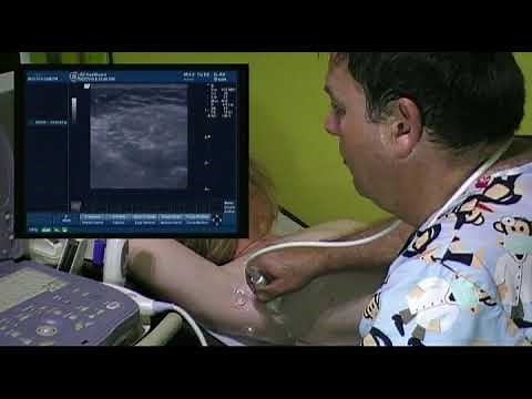 AXILLA ULTRASOUND TECHNIQUE