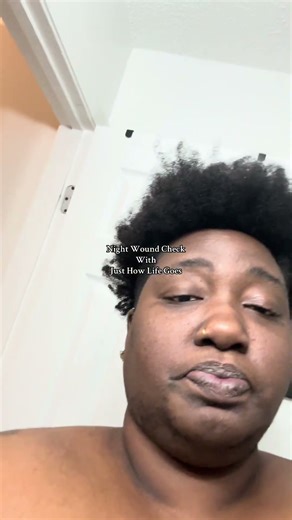 Look at these armpits. Been a journey of years of pain to finally find Remicade. #justhowlifegoes