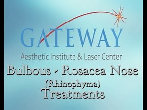 Bulbous Nose Laser Treatment - Rhinophyma