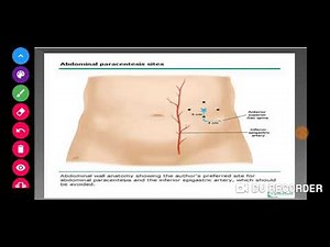 #paracentesis procedure #Fundamental || paracentesis procedure