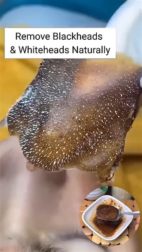 3.3M views · 26K reactions | Remove Blackheads & Whiteheads Naturally At Home . . . #blackheads #whiteheads #blackheadsremoval #whiteheadsremoval #skincare #reelsvideoシ #fbreelsfypシ゚ #reelsviralシ #fbreelsfypシ゚viralシ #reelschallenge #explorepage | Natural Beauty Recipes | Facebook