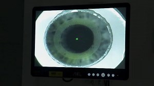 Quarks: Lasern statt Brille: Das kann ins Auge gehen