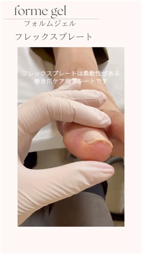 フレックスプレート3回目の施術動画 今までの巻き爪矯正とは全く違う方法