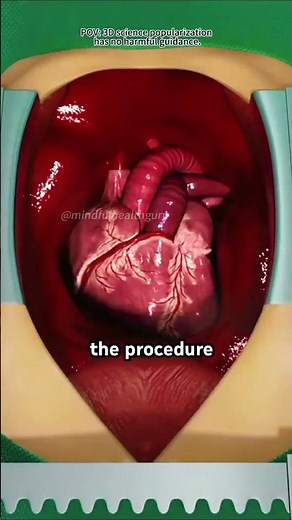 Coronary Artery Bypass Graft Surgery (Open Heart Surgery)