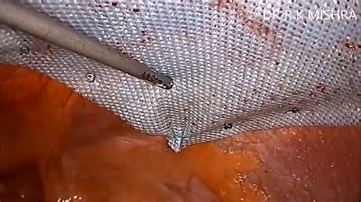 Laparoscopic Repair of Incisional Hernia by Two Ports