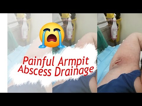 Painful Armpit Abscess Drainage (Pus Drain on Axilla)