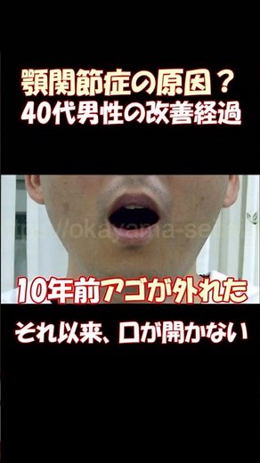【顎関節症】顎が外れて以来10年間口が開かない40代男性の経過と原因を解説