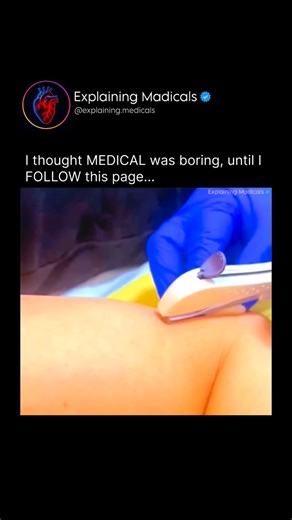 Medical | Health | Anatomy on Instagram: "The single-rod implant is inserted under the skin to provide long-term, reliable birth control using the body’s own biology. Placing it in the subdermal layer allows the implant to steadily release a low dose of hormone directly into the bloodstream over time, without needing daily pills or frequent medical visits. This location is ideal because it’s easy to access, safe, and allows consistent hormone absorption. Biological Purpose & How It Works Once in