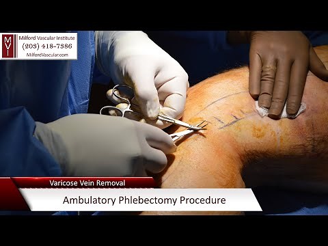 Varicose Vein Removal New Haven CT Ambulatory Phlebectomy Procedure By Best Vascular Surgeon