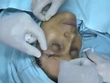 Brow lift using Serdev Suture • Video • MEDtube.net