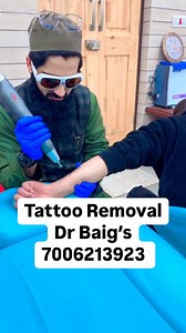 Tattoo Removal at Dr Baigs clinic allochibagh Srinagar 7006213923. Location…. Dr baigs clinic allochibagh gulshan colony near mintocircle school and masjid tyyib monday tuesday friday 2pm to 4pm 9797794193 https://maps.app.goo.gl/Rvre3QdvVP6uHf4w7?g_st=ic. #tattooremoval #tattoo #lasertattooremoval #laser #microblading #skincare #tattoos #laserhairremoval #beauty #tattooremovalspecialists #lasertreatment #skinrejuvenation #pmu #permanentmakeup #tattooregret #eyebrows #laserremoval #lasertattoo #