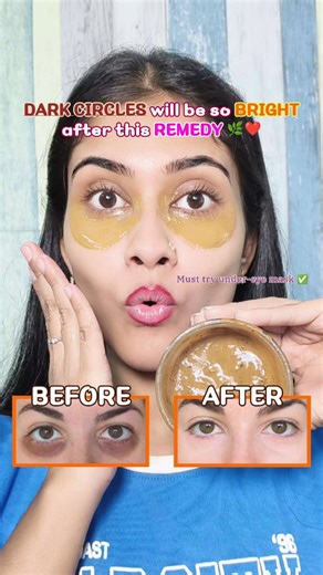 DIY Dark Circle Mask that actually works!✨🩷 #darkcircles #homeremedies #viral #explore