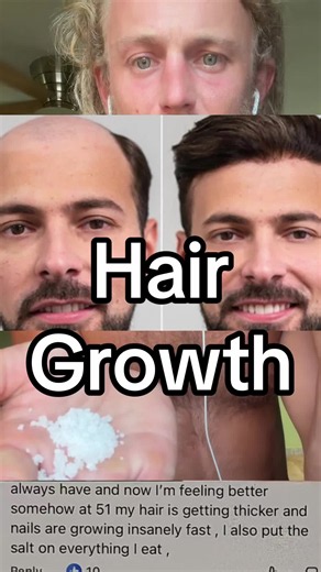 Real salt helps regrow and regenerate your hair loss isssues.. Magnesium is one of the building blocks of hair and like everything in your body . Focus on magnesium’ and copper dense food /natural substances . Salt every offering -Levi 2:13 Have Goats Milk-Proverbs 27:27=detoxes and heals body reversing ALL major mineral deficiency’s. Herbs will heal the nations -Rev 22:2 …=do the masters cleanse daily Clean Cayenne ..Beef Liver and Hand harvested and crafted salt 🧂 and clean keylimes in our li