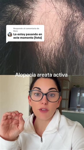Importancia de la Alopecia Areata: Consejos para el Tratamiento
