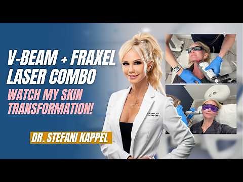 VBeam + Fraxel Journey | Day by Day Results